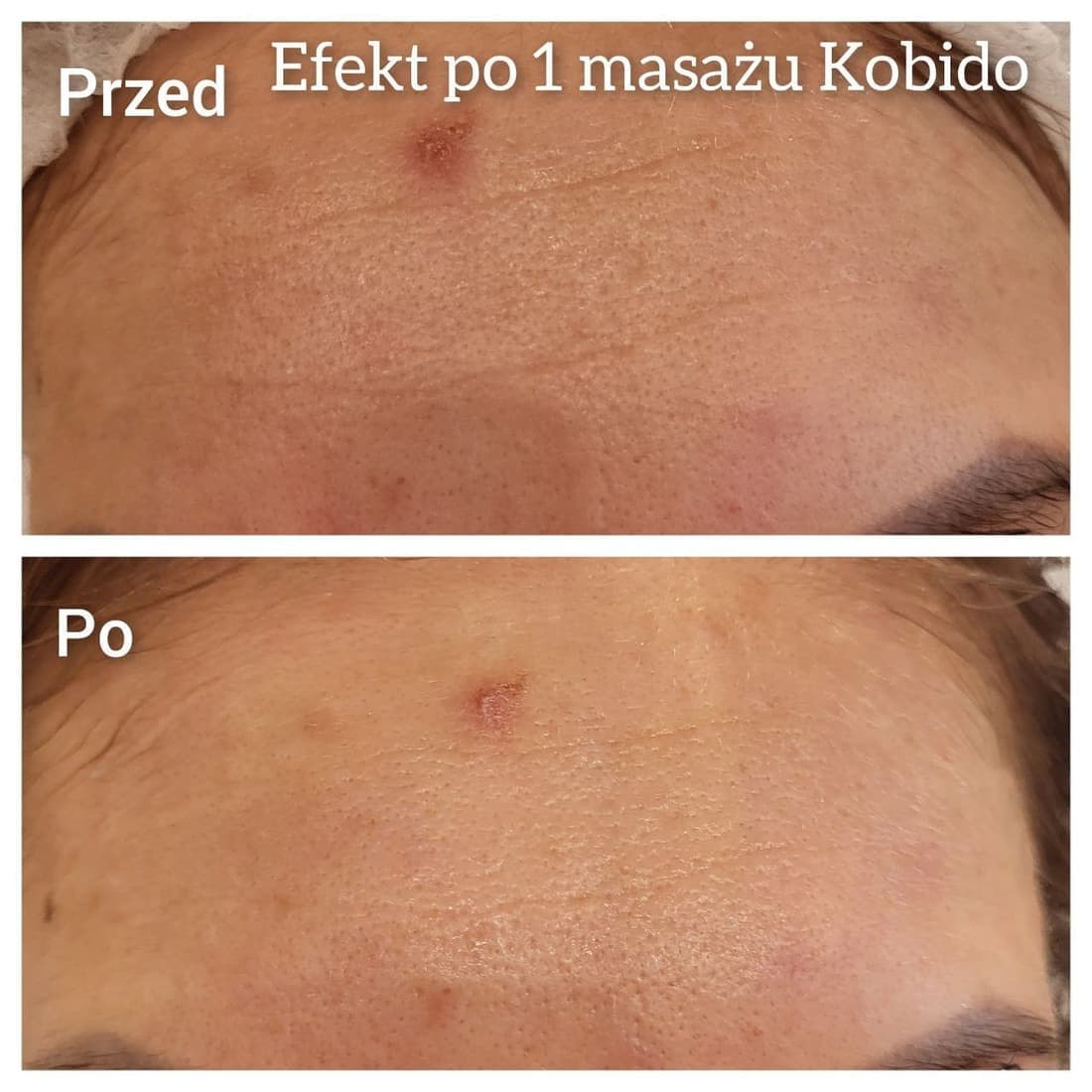 Efekt po masażu Kobido