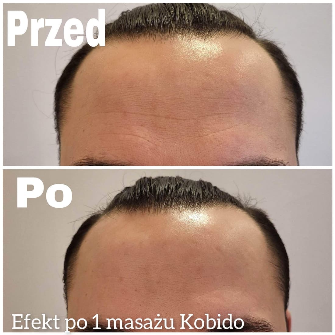 Efekt po masażu Kobido